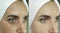Woman  eye wrinkles removal therapy before  cosmetology rejuvenation mature regeneration treatment collage