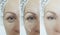 Woman eyes wrinkles before after collage treatment arrow blepharoplasty