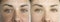 Woman eyes wrinkles before  correction   procedure  removal concept pigmentation difference results treatment revitalization