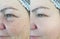 Woman eyes wrinkles before and after rosacea correction treatment plastic blepharoplasty