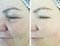 Woman eyes wrinkles before and after treatment  blepharoplasty