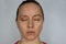 woman face recovery after plastic surgery, blepharoplasty operation, visible eyes wound cuts