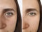 Woman face removal correction wrinkles before and after treatment collage