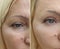 Woman face wrinkles before after beautician difference rejuvenation correction tension