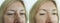 Woman face wrinkles before after beautician thread rejuvenation plastic difference effect procedure lifting treatment collage