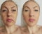 Woman face wrinkles before and after collage treatment
