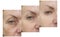 Woman face wrinkles contrast  effect  correction removal rejuvenation concept tightening before and after treatment collage