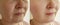 Woman face wrinkles contrast removal concept tightening before and after treatment collage