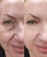 Woman face wrinkles contrast removal  rejuvenation  concept tightening before and after treatment collage