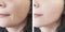Woman face wrinkles before and after correction results tension cosmetology procedures