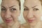 Woman face wrinkles correction before and after revitalization collage treatment