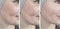 Woman face wrinkles cosmetology arrow difference effect eye removal before and after treatment