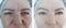 Woman face wrinkles cosmetology effect eye removal before and after treatment