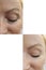 Woman face wrinkles cosmetology rejuvenation difference lifting effect before and after correction