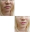 Woman face wrinkles cosmetology therapy difference lifting effect before and after correction