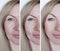 woman face wrinkles cosmetology treatment dermatology beautician removal before and after procedures, arrow