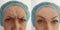 Woman face wrinkles differen before and after therapy woman face wrinkles before and after treatment, collage treatment, collage