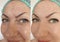 Woman face wrinkles differen after therapy woman face wrinkles before and after treatment, collage treatment, collage