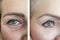 Woman face wrinkles after effect beautician patient difference rejuvenation tension