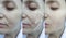 Woman face wrinkles before and after  facelift collage procedure  treatment