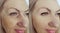 Woman face wrinkles before and after lifting collage treatment