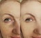 Woman face wrinkles before and after lifting difference collage treatment