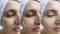 Woman face wrinkles before after lifting therapy correction sagging treatment tightening arrow