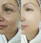 Woman face wrinkles before and after plastic difference treatment collage