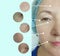 Woman face wrinkles  procedure patient  regeneration cosmetology before and after collage rejuvenation treatment