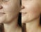 Woman face wrinkles regeneration cosmetology procedure tightening removal treatment collage