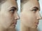 Woman face wrinkles regeneration filler cosmetology procedure tightening removal treatment collage