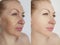 Woman face wrinkles before and after regeneration lifting difference collage treatment