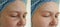 Woman face wrinkles removal concept tightening before and after treatment collage