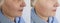 Woman face wrinkles  removal  cosmetology concept tightening before and after treatment collage