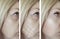 Woman face wrinkles removal cosmetology dermatology patient medicine before and after difference treatment procedures, arrow