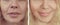 Woman face wrinkles removal after effect beautician patient difference rejuvenation tension