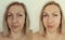 Woman face wrinkles removal lifting  result before after treatment collage