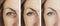 Woman face wrinkles removal results cosmetology patient medicine before and after difference treatment procedures, arrow