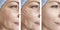 Woman face wrinkles result procedure rejuvenation lifting removal difference before and after correction