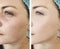 Woman face wrinkles before and after tension cosmetology procedures