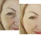 Woman face wrinkles tension before and after difference  facelift collage procedure treatment