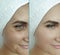 Woman face wrinkles before  after treatment collage