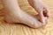 A woman has pain on her feet. Nail fungus on the feet