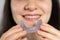 A woman holds dental mouthguard, splint for the treatment of dysfunction of the temporomandibular joints, bruxism