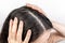 The woman holds her head with her hands, showing a parting of dark hair with dandruff. Close up. The view from the top. Zoomed