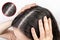 The woman holds her head with her hands, showing a parting of dark hair with dandruff. Close up. The view from the top. Zoomed