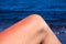 Woman leg with red sunburn skin on blue sea background. Sun burned skin redness and irritation