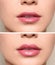 Woman before and after lips augmentation procedure,