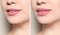 Woman before and after lips augmentation procedure