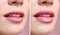 Woman before and after lips augmentation procedure